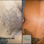 Full Brazilian Laser Hair Removal Before and After Photos