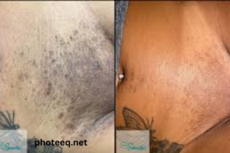 Full Brazilian Laser Hair Removal Before and After Photos