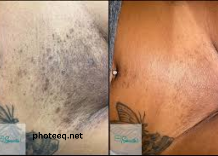Full Brazilian Laser Hair Removal Before and After Photos