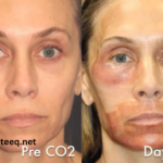 Day by Day Co2 Laser Resurfacing Recovery Photos