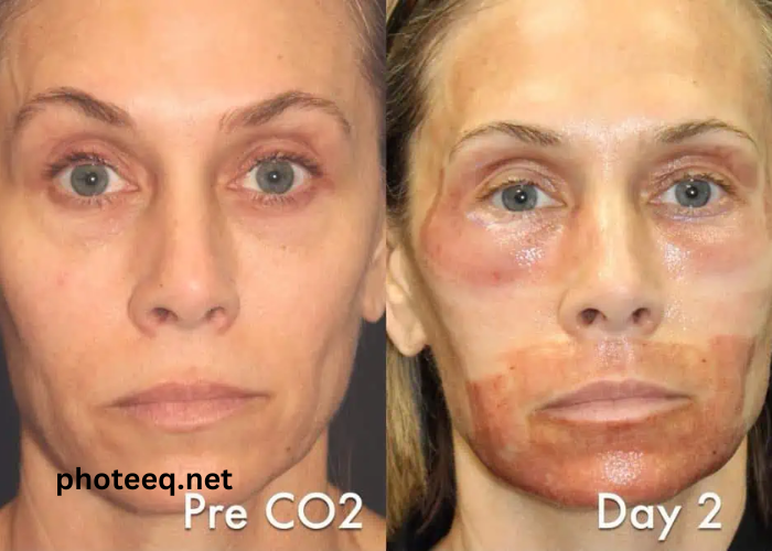 Day by Day Co2 Laser Resurfacing Recovery Photos